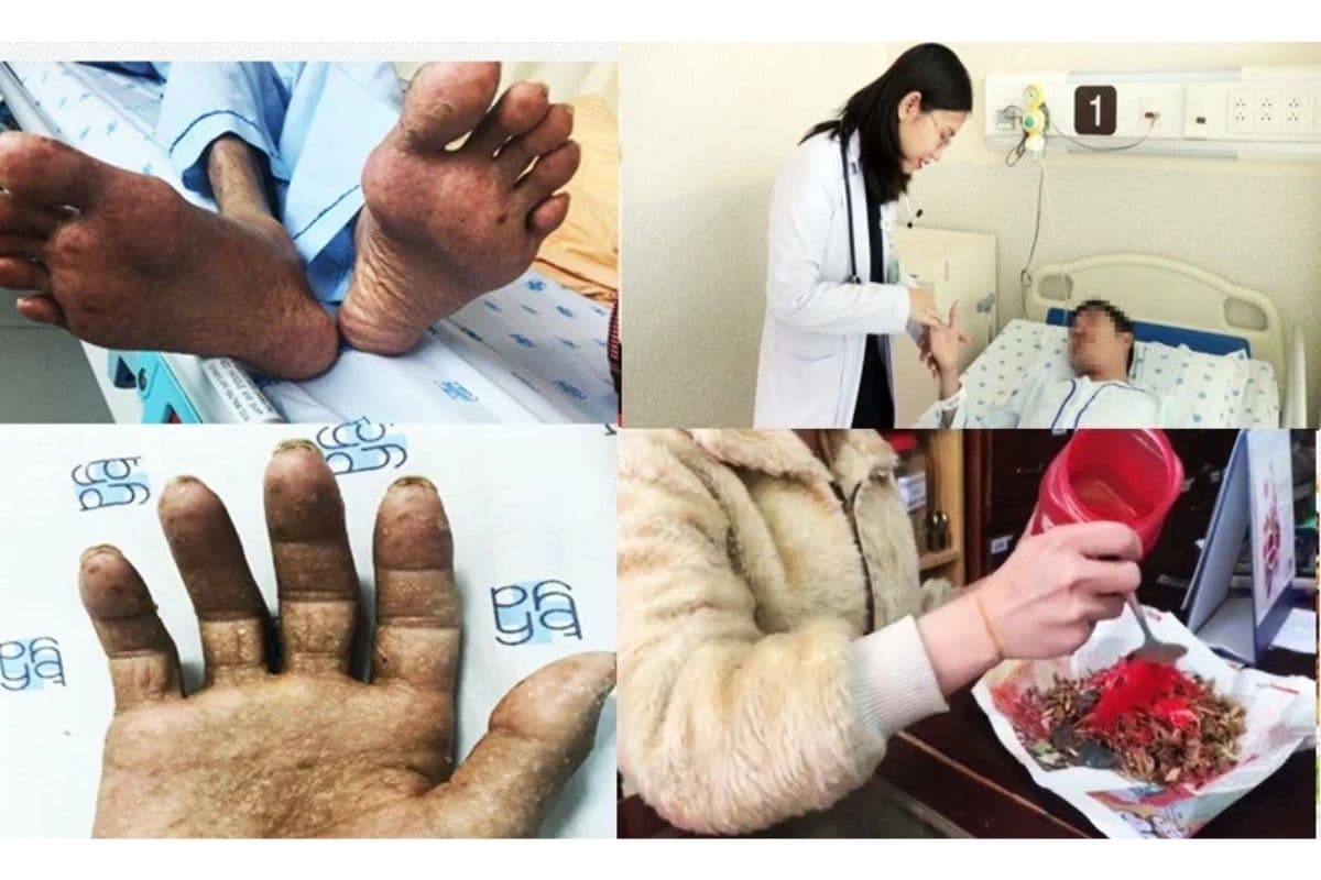 Tác động tiêu cực của nước nhiễm kim loại nặng đến sức khỏe và làn da