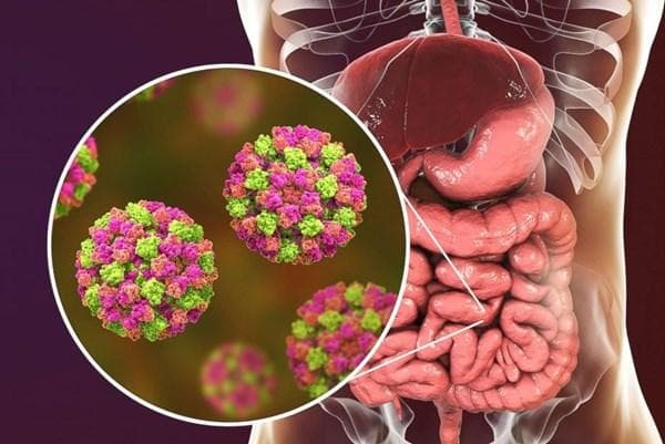 Viêm dạ dày ruột do noro virus trong nước gây ra