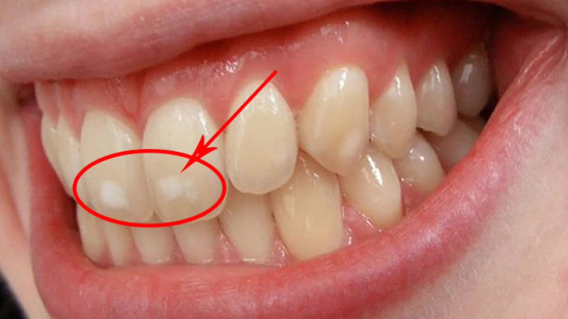 Lượng fluoride trong nước quá cao có thể gây hại đến răng